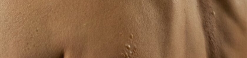 Kalkschulter: Bewegung oder Ruhe für eine schnelle Genesung?